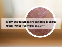 指甲型银屑病指甲裂开了算严重吗 指甲型银屑病指甲裂开了算严重吗怎么治疗