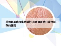 兰州银屑病打生物制剂 兰州银屑病打生物制剂的医院