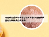 银屑病治疗表彰长春华山3 长春华山皮肤病医院治银屑病能去根吗