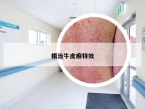 根治牛皮癣特效