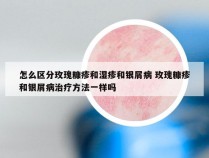 怎么区分玫瑰糠疹和湿疹和银屑病 玫瑰糠疹和银屑病治疗方法一样吗