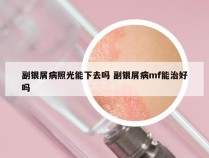 副银屑病照光能下去吗 副银屑病mf能治好吗