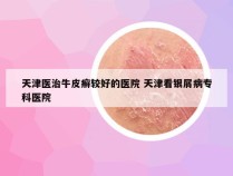 天津医治牛皮癣较好的医院 天津看银屑病专科医院