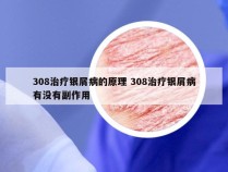 308治疗银屑病的原理 308治疗银屑病有没有副作用