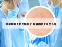 银屑病脸上也开始长了 银屑病脸上长怎么办