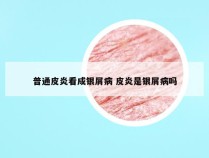 普通皮炎看成银屑病 皮炎是银屑病吗
