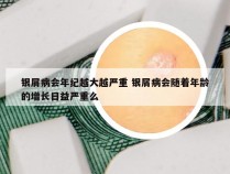 银屑病会年纪越大越严重 银屑病会随着年龄的增长日益严重么