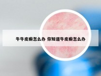 牛牛皮癣怎么办 你知道牛皮癣怎么办