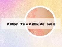 银屑病涂一夫百应 银屑病可以涂一抹灵吗