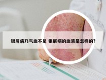 银屑病乃气血不足 银屑病的血液是怎样的?