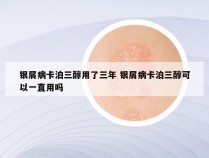 银屑病卡泊三醇用了三年 银屑病卡泊三醇可以一直用吗