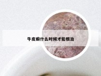 牛皮癣什么时候才能根治