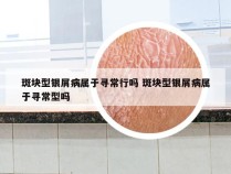 斑块型银屑病属于寻常行吗 斑块型银屑病属于寻常型吗