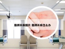 胳膊长癣图片 胳膊长癣怎么办