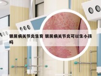 银屑病关节炎生育 银屑病关节炎可以生小孩吗