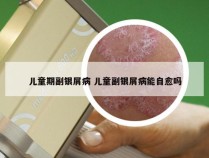 儿童期副银屑病 儿童副银屑病能自愈吗