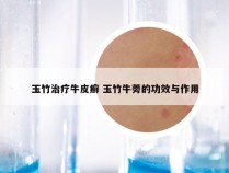 玉竹治疗牛皮癣 玉竹牛蒡的功效与作用
