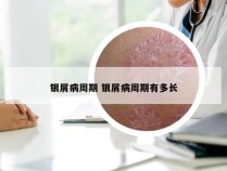 银屑病周期 银屑病周期有多长