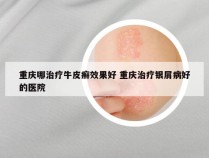 重庆哪治疗牛皮癣效果好 重庆治疗银屑病好的医院