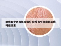 蚌埠有中医治银屑病吗 蚌埠有中医治银屑病吗在哪里