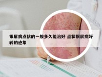 银屑病点状的一般多久能治好 点状银屑病好转的迹象