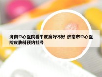 济南中心医院看牛皮癣好不好 济南市中心医院皮肤科预约挂号