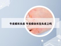 牛皮癣长头皮 牛皮癣会长在头皮上吗
