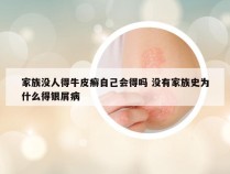 家族没人得牛皮癣自己会得吗 没有家族史为什么得银屑病