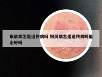 银屑病怎是遗传病吗 银屑病怎是遗传病吗能治好吗