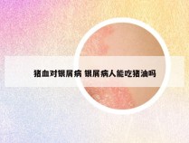 猪血对银屑病 银屑病人能吃猪油吗