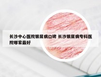 长沙中心医院银屑病口碑 长沙银屑病专科医院哪家最好