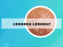 儿童银屑病普通 儿童银屑病治疗
