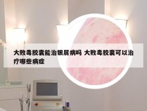 大败毒胶囊能治银屑病吗 大败毒胶囊可以治疗哪些病症
