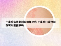 牛皮癣生物制剂影响怀孕吗 牛皮癣打生物制剂可以要孩子吗