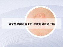 得了牛皮癣不能上班 牛皮癣可以进厂吗