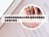 治好脓包型银屑病大约费用 脓包型银屑病怎么能减少复发