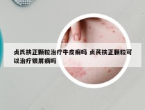 贞氏扶正颗粒治疗牛皮癣吗 贞芪扶正颗粒可以治疗银屑病吗