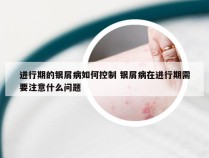 进行期的银屑病如何控制 银屑病在进行期需要注意什么问题