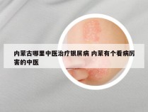 内蒙古哪里中医治疗银屑病 内蒙有个看病厉害的中医