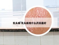乳头癣 乳头癣用什么药膏最好