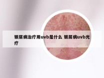 银屑病治疗用uvb是什么 银屑病uvb光疗