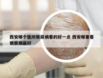 西安哪个医院银屑病看的好一点 西安哪里看银屑病最好