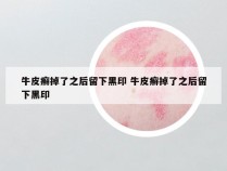 牛皮癣掉了之后留下黑印 牛皮癣掉了之后留下黑印