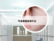 牛皮癣是身体什么