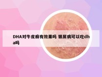 DHA对牛皮癣有效果吗 银屑病可以吃dha吗