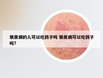 银屑病的人可以吃鸽子吗 银屑病可以吃鸽子吗?