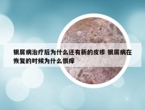 银屑病治疗后为什么还有新的皮疹 银屑病在恢复的时候为什么很痒