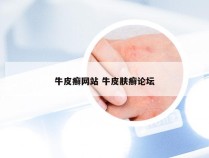 牛皮癣网站 牛皮肤癣论坛
