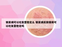 银屑病可以吃氯雷他定么 银屑病皮肤瘙痒可以吃氯雷他定吗