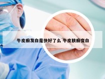 牛皮癣发白是快好了么 牛皮肤癣变白